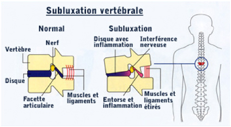 clinique-chiropatenaude-chiropraticienne-terrebone-subluxation-vertebral
